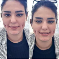 اموزش وخدمات چال گونه وپرسینگ در کلینیک