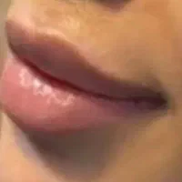 ژل وفیلر بوتاکس نورافیل ۱تومن فیلر بادی وباسن