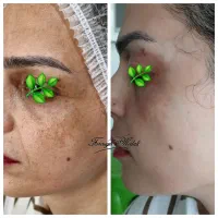 حذف تک جلسه ای لک و کک مک کلینیک|خدمات آرایشگری و زیبایی|رشت, گلسار|دیوار