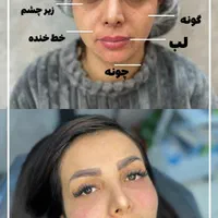 پی ار پی ژل بوتاکس فیلر نخ مزو لیزر ریمو تتو مزوژل|خدمات آرایشگری و زیبایی|مشهد, هفت تیر (حافظ)|دیوار