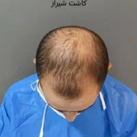 کاشت مو|خدمات آرایشگری و زیبایی|صدرا-فارس, فاز ۱|دیوار