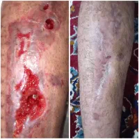 زخم بستر سوختگی دیابتی پرستار