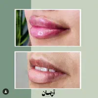 کانتورینگ با فیلر و ژل و لب تخصصی (کاملا طبیعی)|خدمات آرایشگری و زیبایی|مشهد, گلبرگ شمالی|دیوار