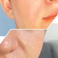 تخفیف عیدانه تزریق ژل،بوتاکس،فشیال.لیزر|خدمات آرایشگری و زیبایی|تهران, نیروی هوایی (پیروزی)|دیوار