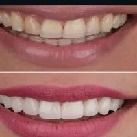 دندانپزشکی ایمپلنت، کامپوزیت، لمینت، بلیچینگ|خدمات زیبایی و سلامت|تهران, خواجه نظام الملک|دیوار