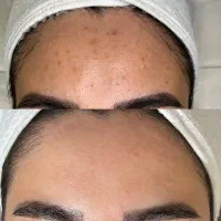 پاکسازی پوست ( فیشال درمانی فقط و فقط ۶۵۰هزارتومن)