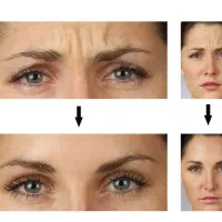 بوتاکس و تزریق فیلر با تخفیف تا یک هفته