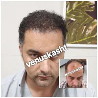 کاشت مو پر تراکم|خدمات آرایشگری و زیبایی|تهران, جردن|دیوار