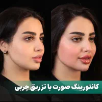 تزریق چربی(صورت،بیکینی،پشت دست)