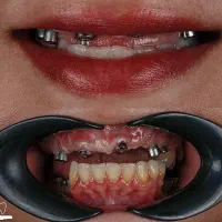 دندانپزشکی ایمپلنت+لمینت+کامپوزیت+ارتودنسی اقساط|خدمات آرایشگری و زیبایی|مشهد, سجاد شهر|دیوار