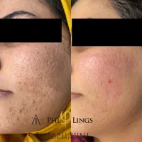 رفع تخصصی جای جوش|خدمات آرایشگری و زیبایی|تهران, قبا|دیوار