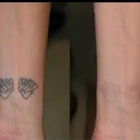 لیزرتتولیزر ابرو.ریموو.پاکسازی تتوبا لیزرکیوسوییچ