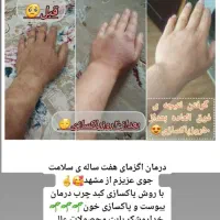 درمان مشکلات پوستی اگزما لک|آرایشی، بهداشتی، درمانی|سرخنکلاته, |دیوار