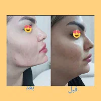 جشنواره تزریق ژل و بوتاکس وانزیم|خدمات آرایشگری و زیبایی|ملارد, |دیوار