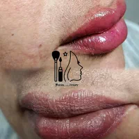 تزریق ژل و بوتاکس