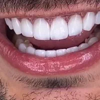 کامپوزیت فکی ۶ تومان/لمینیت / بیلیچینگ/روکش|خدمات آرایشگری و زیبایی|تهران, اوقاف|دیوار