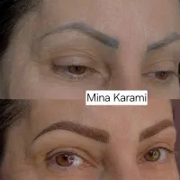 میکروبلیدینگ ابرو