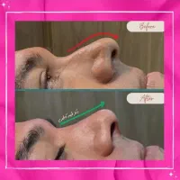 تخفیفات30درصدی ژل و بوتاکس وفیلر دکتر زیبایی|خدمات آرایشگری و زیبایی|مشهد, کوثر|دیوار