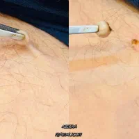 برداشتن انواع خال گوشتی،زگیل،منگوله،کک مک|خدمات آرایشگری و زیبایی|شیراز, شهرک امیر کبیر|دیوار