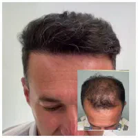کاشت مو،ابرو و ریش طبیعی