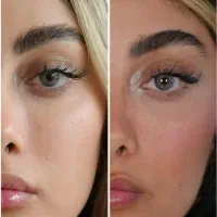 تزریق ژل و بوتاکس ویژه مرداد|خدمات زیبایی و سلامت|تهران, عبدل‌آباد|دیوار