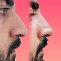 اصلاح قوزوافتادگی بینی بدون جراحی در مطب( تضمینی)|خدمات آرایشگری و زیبایی|شاهینشهر, فردوسی|دیوار