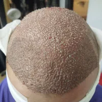 کاشت مو/مزو/پی آر پیprp