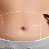 لیپوماتیک فرمدهی طبیعی+اقساطی ویژه (ظرفیت محدود)