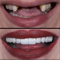 جشنواره دندانپزشکی دی ،اقساط بلند مدت|خدمات آرایشگری و زیبایی|ایلخچی, |دیوار