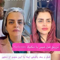 تخفیف طلایی بوتاکس و مزوتراپی|خدمات آرایشگری و زیبایی|تهران, جماران (نیاوران)|دیوار