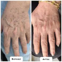 رفع کک و مک و خال