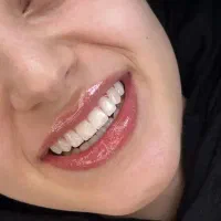 کشیدن عقل نهفته و ایمپلنت