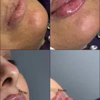 تخفیف ویژه ژل وبوتاکس|خدمات آرایشگری و زیبایی|ایذه, |دیوار