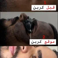 تخفیف ویژه کربن تراپی با پیشرفته ترین دستگاه|خدمات آرایشگری و زیبایی|اهواز, کیانپارس |دیوار