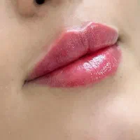 ژل، بوتاکس،لیزر،پی ارپی،فیشیال