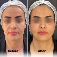 لیفت BAU فیس لیفت صورت اصلاح افتادگی لاغری صورت|خدمات آرایشگری و زیبایی|مشهد, هفت تیر (حافظ)|دیوار