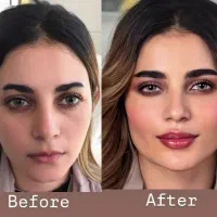 تزریق ژل فیلرفول فیس مزوتراپی بوتاکس PRP پوست و مو