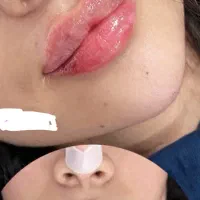 تزریقات زیبایی|خدمات آرایشگری و زیبایی|قرچک, مهدیه|دیوار