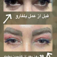 بلفاروپلاستی فقط ۶ میلیون