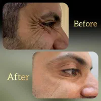 جشنواره بوتاکس پاییزه فقط تا پایان آبان ماه|خدمات آرایشگری و زیبایی|اصفهان, جلفا|دیوار