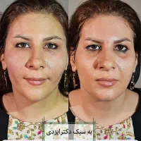 لیپو ساکشن تزریق چربی فیلر بادی صورت و بدن لابیا