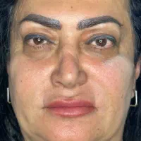 جشنواره اندولیفت تخصصی صورت وگردن|خدمات آرایشگری و زیبایی|تهران, جماران (نیاوران)|دیوار