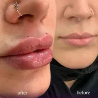 جشنواره50%کلینیک تزریق ژل هیرفیلر پروفایلو لیزر|خدمات زیبایی و سلامت|تهران, طرشت|دیوار