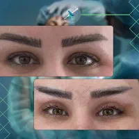 جراحی زیبایی بلفاروپلاستی