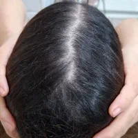 درمان قطعی موخوره و ریزش مو رایگان شد.|خدمات آرایشگری و زیبایی|رشت, کوی بیانی|دیوار