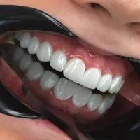 دندان پزشکی/دندانسازی/کامپوزیت/روکش/عصب کشی