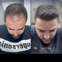 کاشت مو به روش میکروگرافت