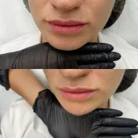 قویترین لیزر الکس شاتی رشت توتال ۹۹۰ با رفع تیرگی|خدمات زیبایی و سلامت|رشت, گلسار|دیوار