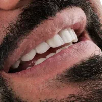 لمینت - کامپوزیت-بلیچینگ-جرمگیری