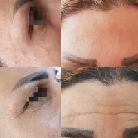 انجام لاین ژل وبوتاکس